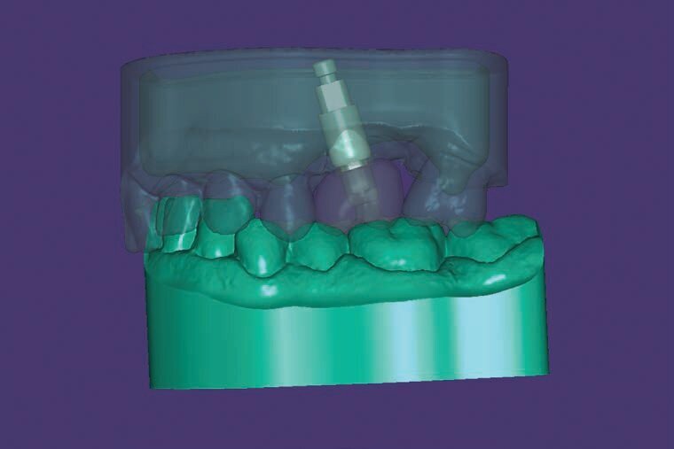 Fig. 9 - Creazione del file per stampa del modello virtuale contenente lo spazio per l’analogo.