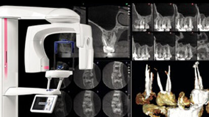 Nuova modalità di imaging endodontico da Planmeca - immagini dettagliate senza rumore o artefatti