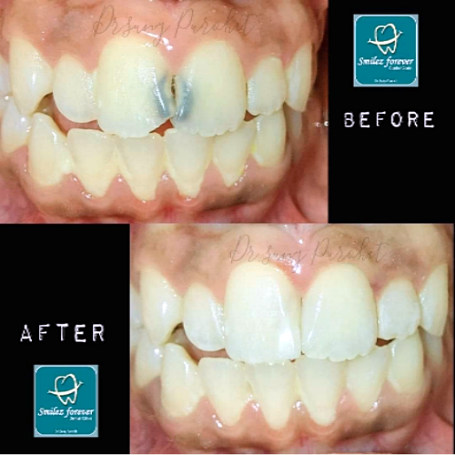The photograph has low value and high brightness and post-op photograph showed heavy light reflection.  Inference: photo might have been taken under two sources of light. 