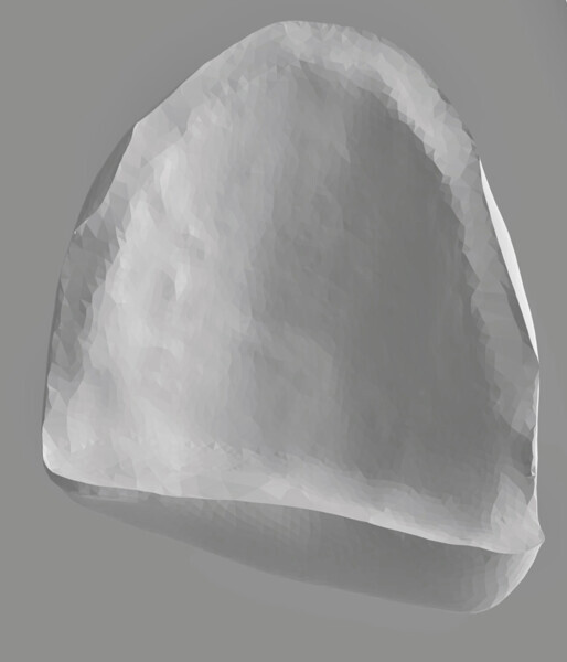 Fig. 5: Design for veneer for tooth #22, lingual view.