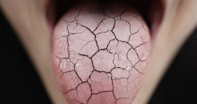 “We are thinking beyond dentistry”: Study helps clinicians identify Sjögren’s syndrome
