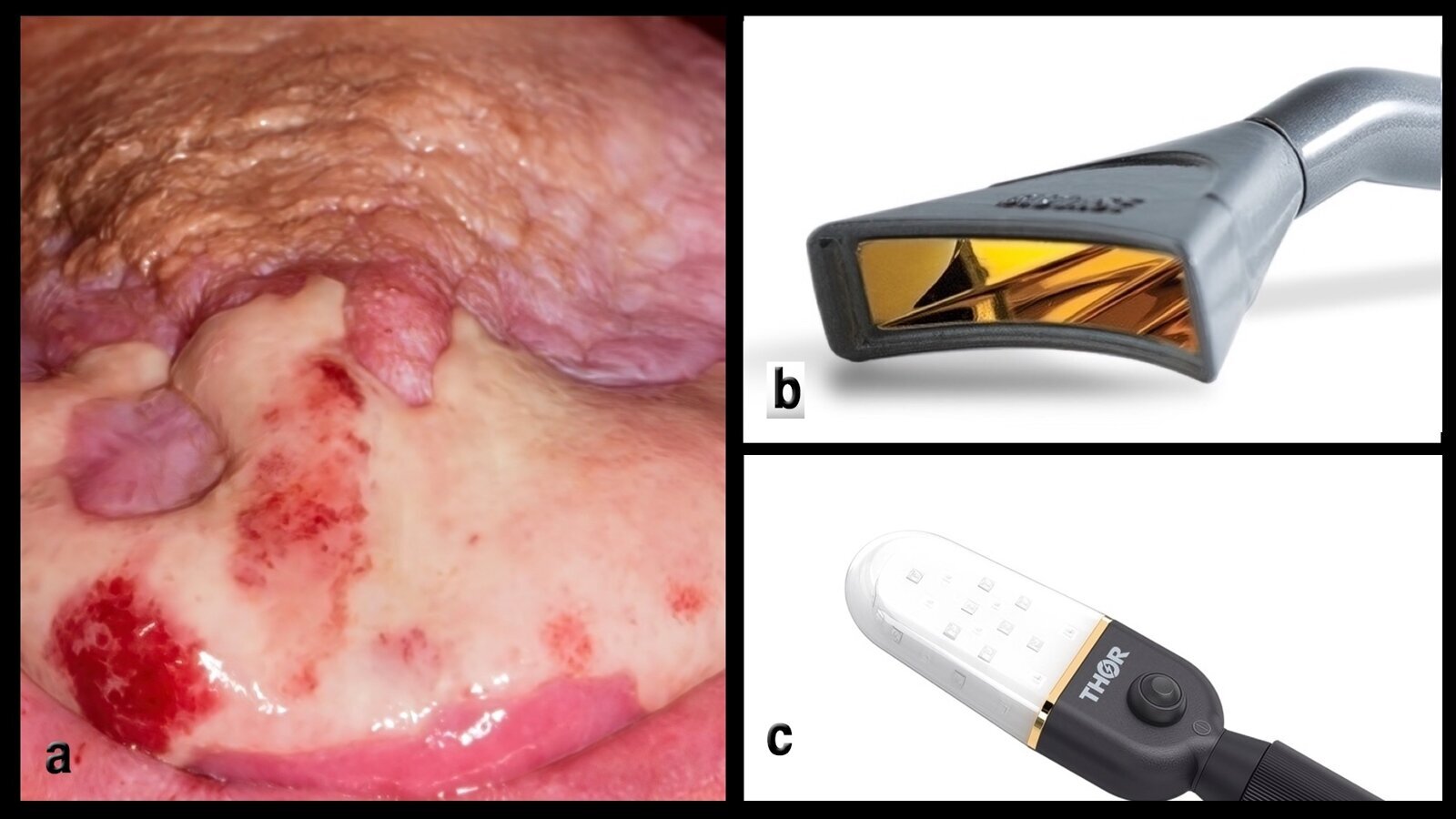 Fotobiomodulación para el tratamiento de la mucositis producida por quimio o radioterapia (2)