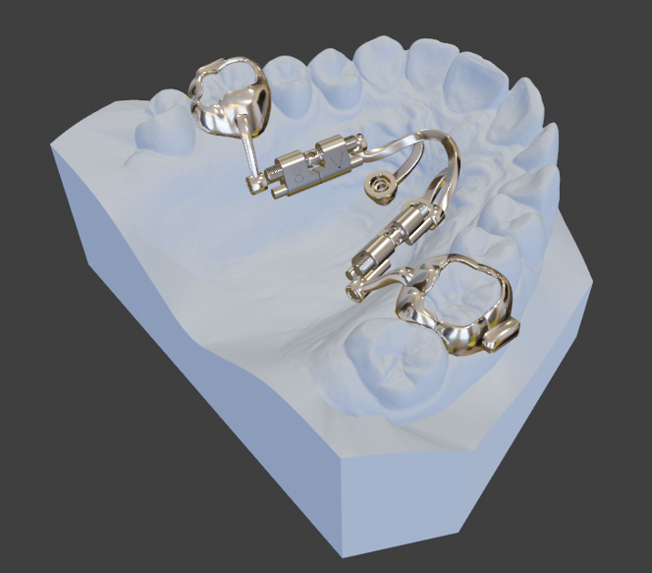 Fig. 4: Digital planning of the distaliser with metal attachments on the shells.