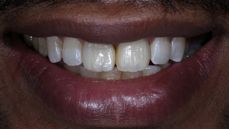 Fig 20 Final smile 