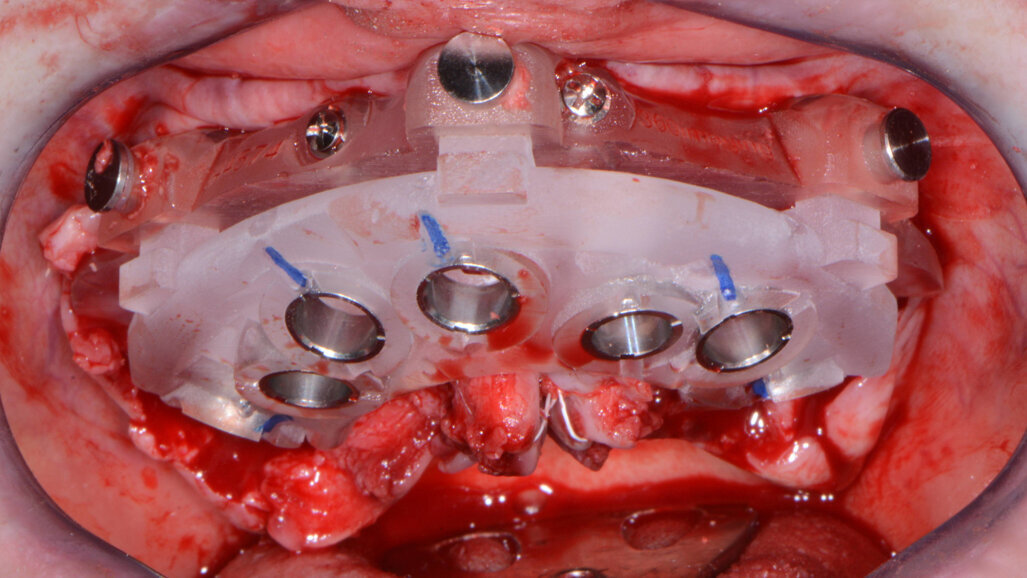 Full-arch CBCT-guided implant rehabilitation