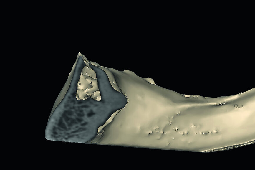Fig. 11a: The ‘clipping’ view with simulated implants reveals ‘hollow’ areas in the symphysis.