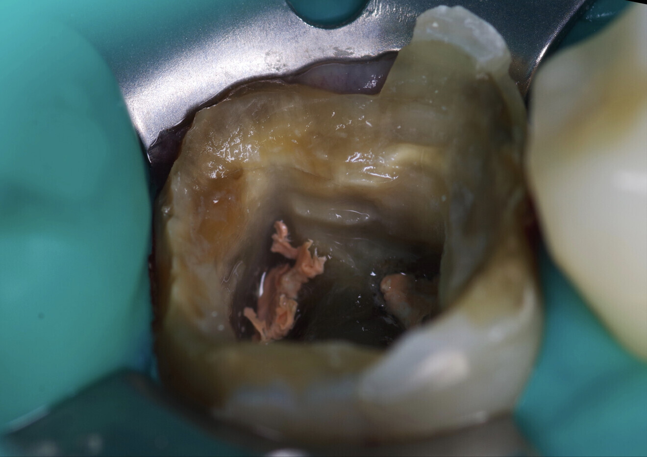 Fig. 5: Large volume of the enlarged pulp chamber. There were undercuts over the lingual wall. The remaining tissue was thin.