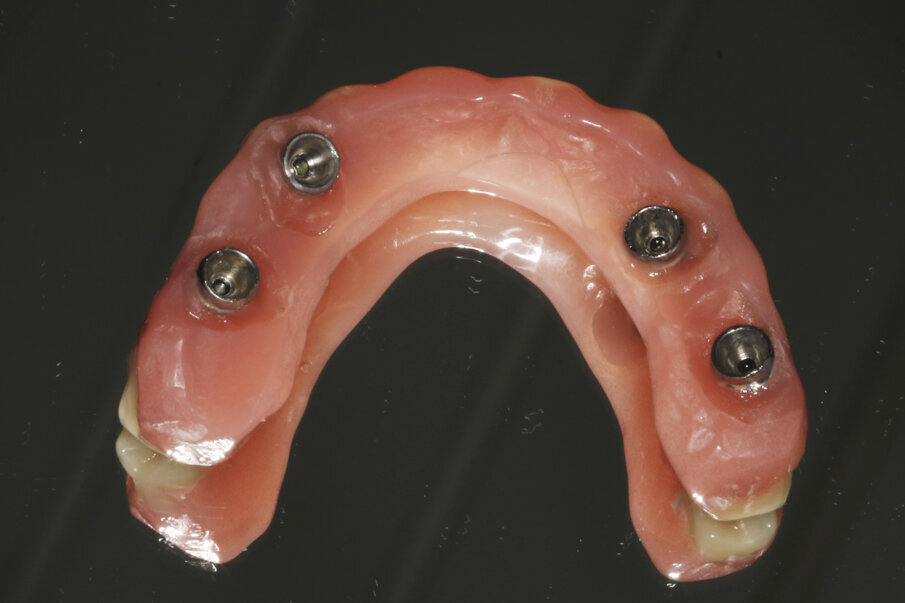 Fig. 12: Seating surface of the provisional prosthesis.