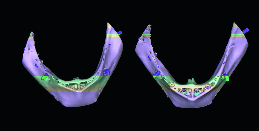 Fig. 12: The mandibular 3-D reconstructed volumes illustrating the hollow areas and potential implant receptor sites.