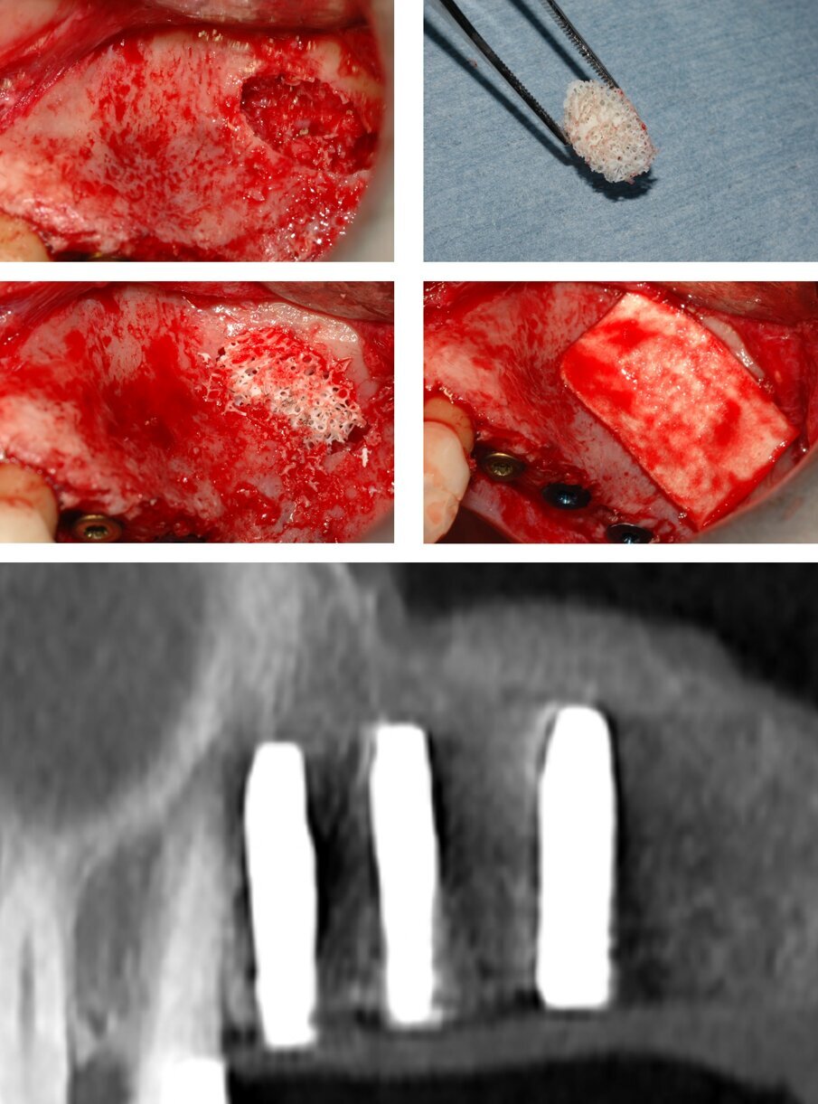 Fig. 6_Il riempimento è completato con la miscela di osso autologo e sostituto osseo di origine equina in granuli; è utilizzato anche un altro frammento del blocco osseo precedentemente descritto. La CBCT di controllo evidenzia il riempimento corretto del seno ed il blocco osseo interposto tra apice implantare e membrana sinusale. 