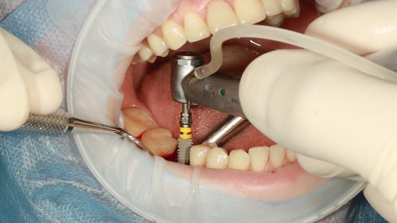 Yapay Zeka, Peri-implantitis Riskini Tahmin Edecek