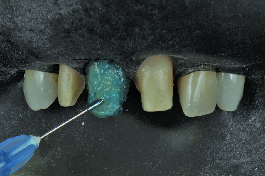 Fig. 16: The veneer preparations are etched with phosphoric acid.