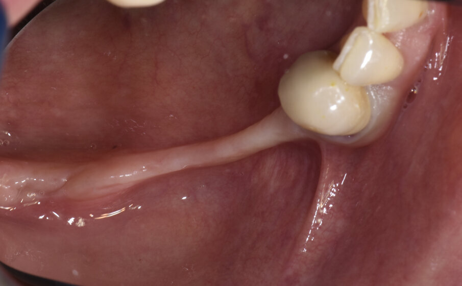 Figg. 1a-1c_Foto clinica e sezioni di CBCT iniziali in cui si evidenzia l’edentulia distale a elemento 4.3 con atrofia orizzontale estremamente accentuata e lieve atrofia verticale.