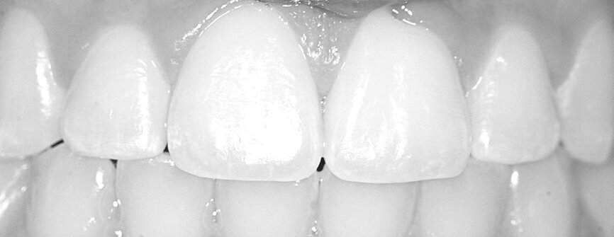 Agnese Graziani's teeth before use of the Dentamask.