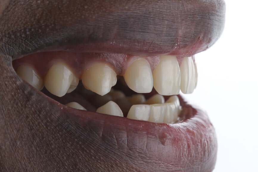 Fig. 7: Initial situation on smiling, lateral and frontal views.