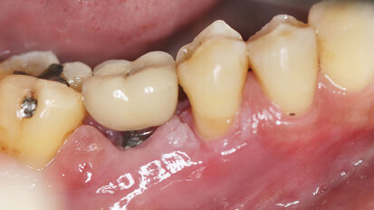 EFP phát hành hướng dẫn về phòng ngừa và điều trị bệnh về implant