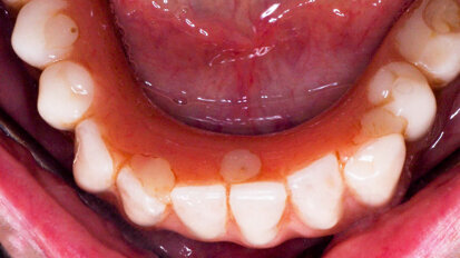 Surgical management of peri-implantitis