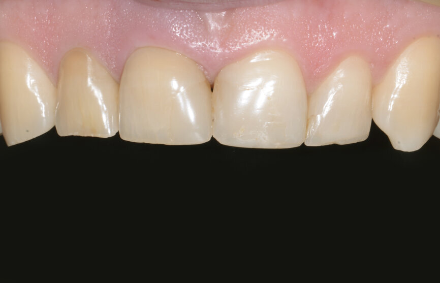 Fig. 1: Situation before treatment, which led to the decision to extract tooth #11.