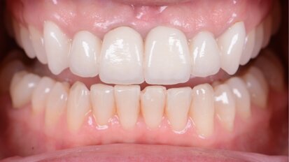 A bright new smile with KATANA Zirconia YML