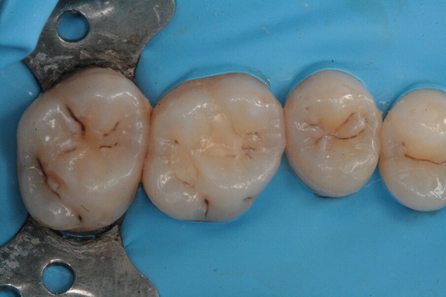 Fig. 6_Isolamento del campo operatorio.
