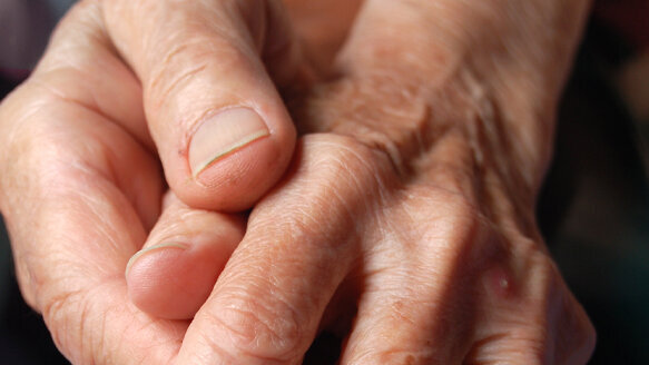 Periodontitis facilitates development and progression of rheumatoid arthritis