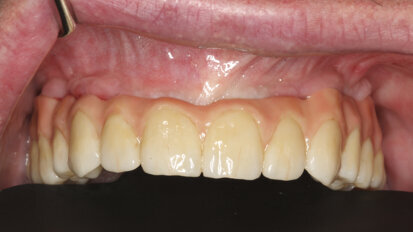 Immediate restoration of an edentulous maxilla