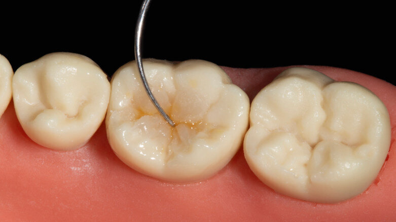 Four questions on current trends in direct posterior and anterior restorations