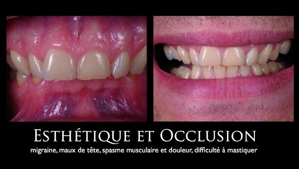 Dentisterie adhésive totale : tout est dans l'équilibre occlusal