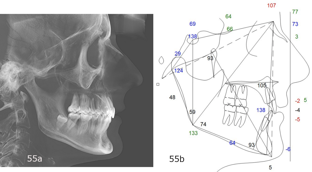 Figs. 55a & b: (a) Cephalometric radiograph and (b) tracing.