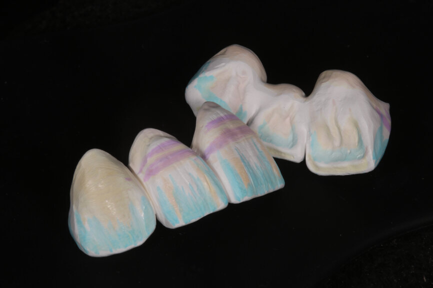 Fig. 9: Vestibular and palatal surfaces individualised with Esthetic Colorant to create and intensify some natural colour effects.