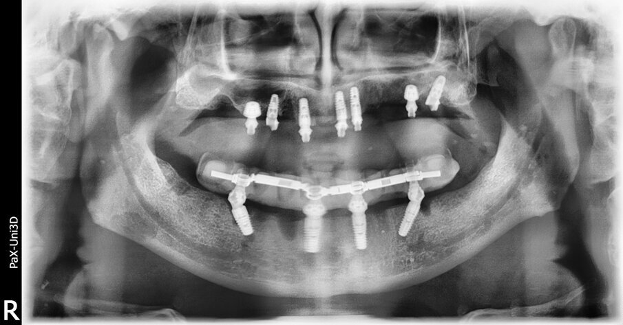 Fig. 6_L’ortopanoramica immediata post-operatoria mostra gli impianti in una buona posizione. Gli impianti ultra-short sono ben inseriti in rapporto ai seni mascellari, seppur circondati da una scarsa quantità di osso.