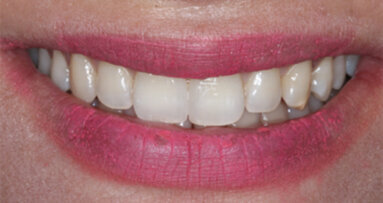 A step-by-step guide to  a direct diastema closure. Case report