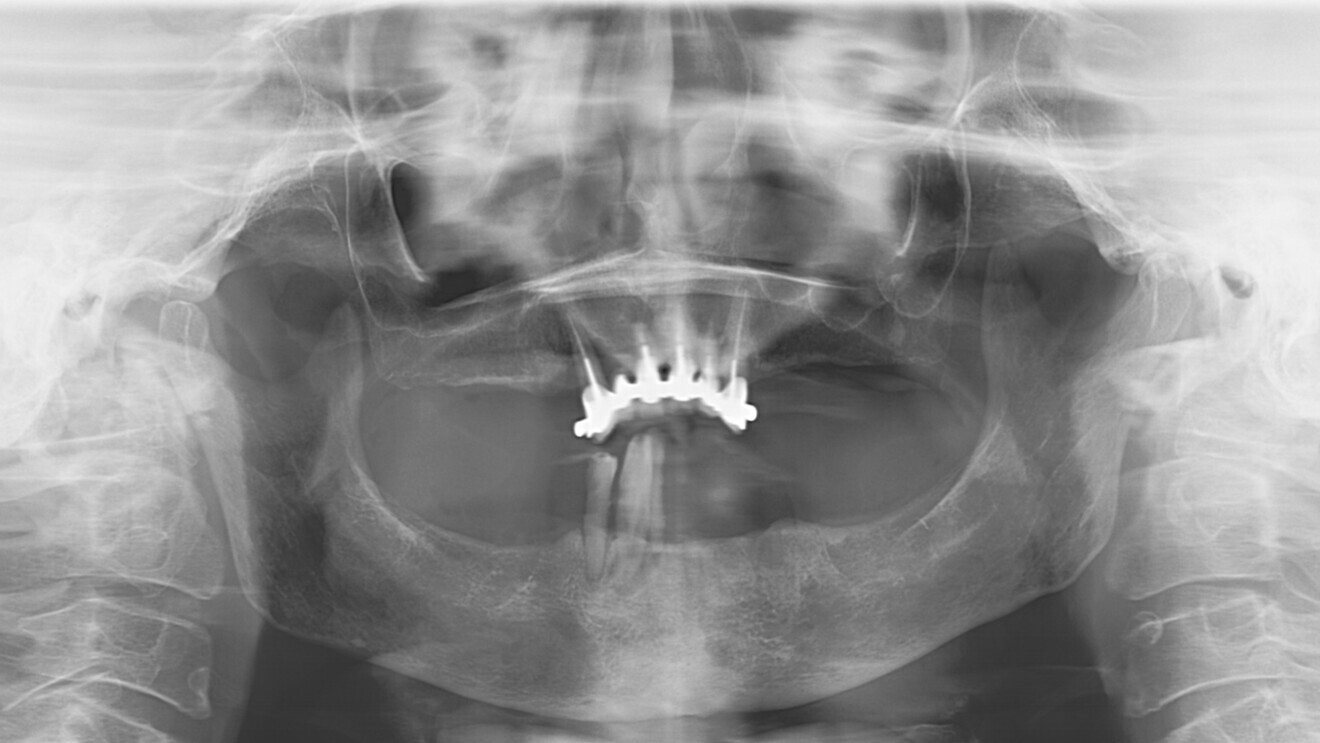 Fig. 3: Dental panoramic tomogram of the clinical situation.