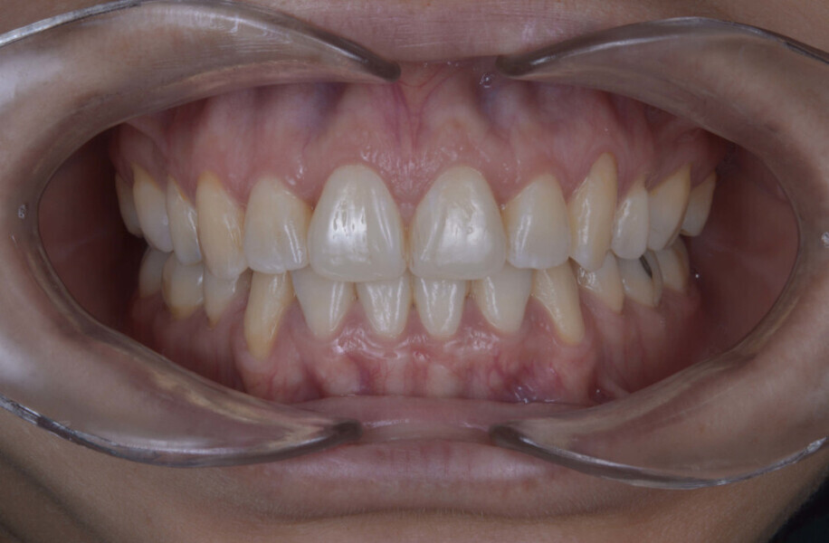 Fig. 7a: Final intra-oral photographs.