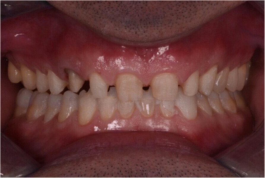 Fig. 9. Dientes posteriores sin preparación y mínima preparación de los dientes anteriores mandibulares, excepto los dientes 11-13 y 21-23 que ya estaban preparados.