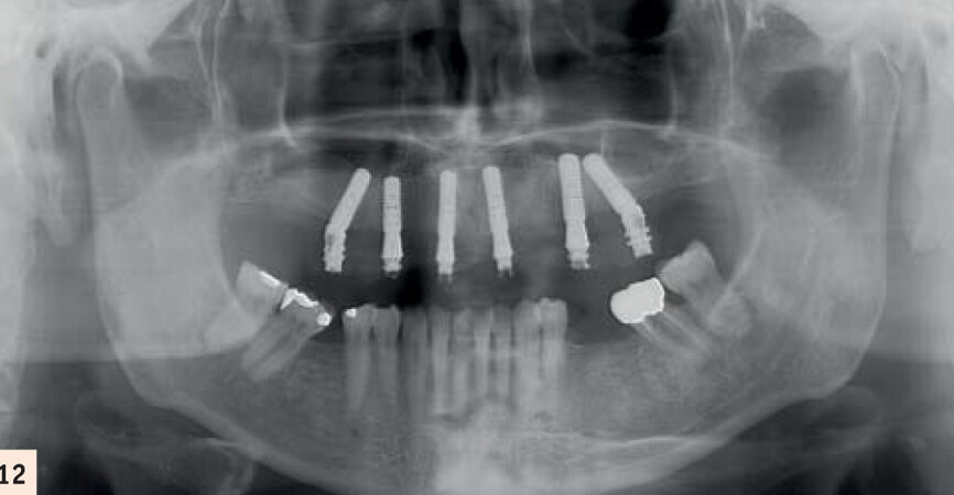Radiographie après la période d’ostéoactivation.