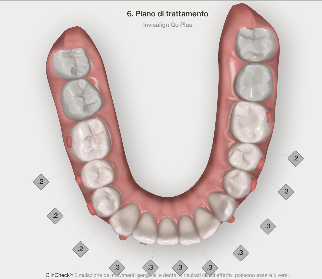 Figg. 4–7 - Pianificazione digitale nelle due arcate prima (Figg. 4, 5) e dopo (Figg. 6, 7). I numeri nel quadrato indicano la riduzione interprossimale pianificata.