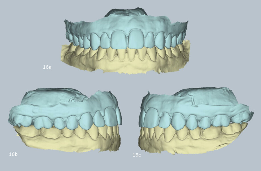 Figs. 16a–c: Virtual articulator mounting with MODJAW demonstrating orthopaedic stability.