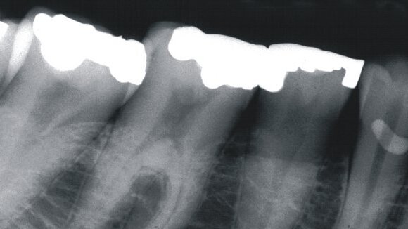 Les radiographies dentaires peuvent prédire les fractures