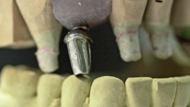Abutment fracture in a bridge supported by natural teeth and implants