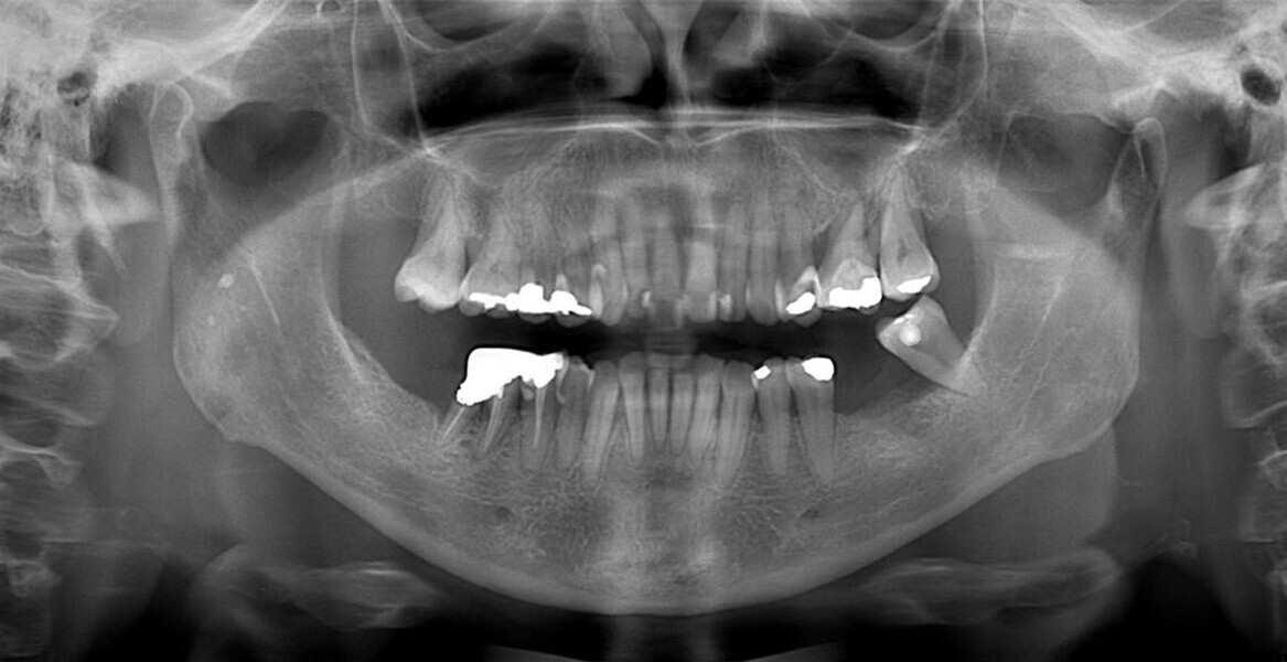 Fig. 5: Panoramic radiograph.