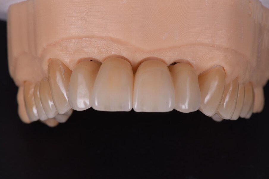 Fig. 45_Il modello digitale rappresenta un mezzo per presentare il restauro nel progetto. È eseguito a computer e solo alcune modifiche vengono fatte, come l’aggiunta di ceramica per enfatizzare l’aspetto estetico. Altro significato è deputato alla precisa posizione degli analoghi implantari.
