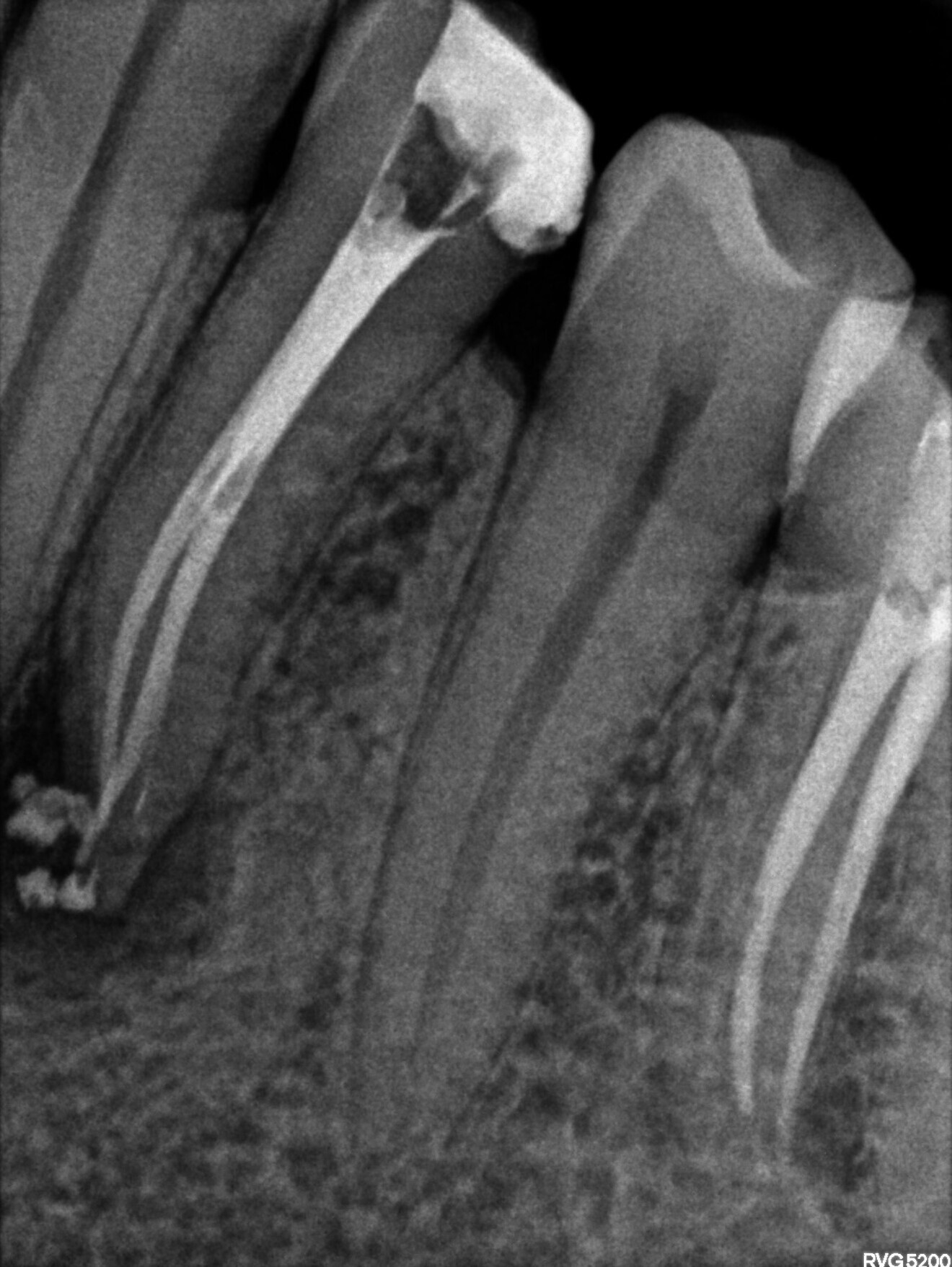 Fig 4. Post-op xray
