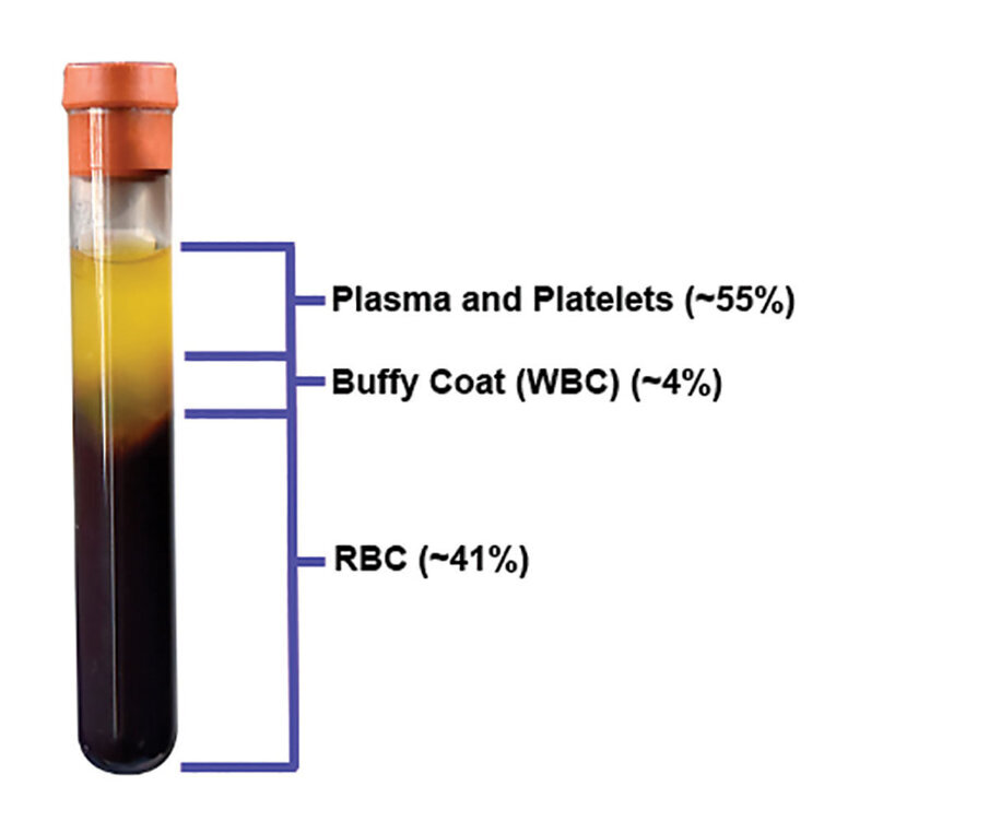 Fig. 10: Following centrifugation, the blood separates into several layers as outlined in Fig. 9.