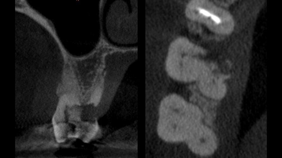 Figg. 2a, 2b - CBCT pre-estrazione