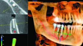 CBCT—种植选择的清晰透视