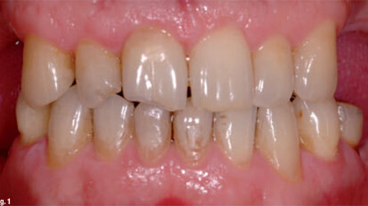 Fixed prosthodontic management of a mutilated dentition: A team approach