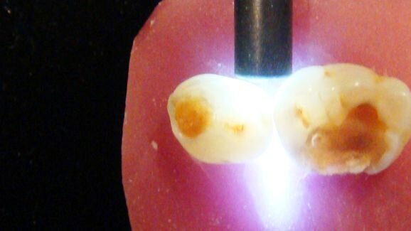 Detecting dental caries: Is there anything new?