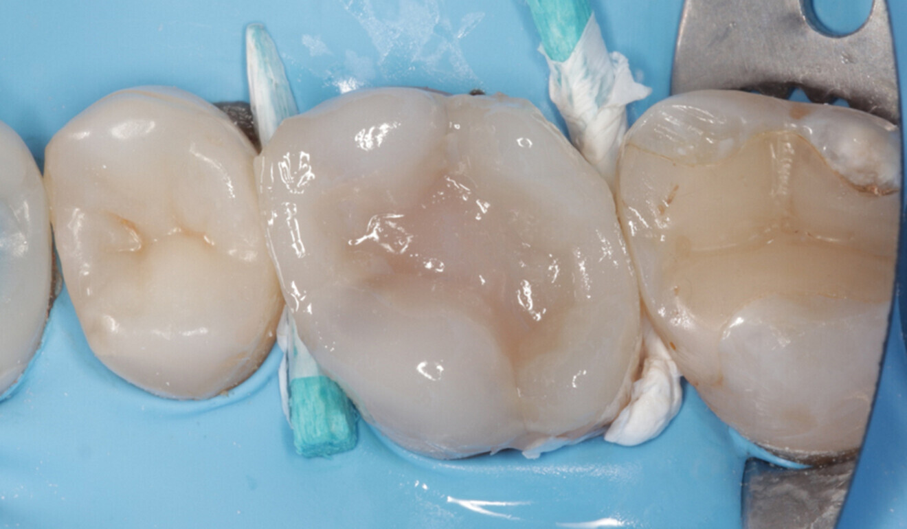 Fig. 15: Cusp coverage, occlusal view. (Image: Kuraray Noritake Dental)
