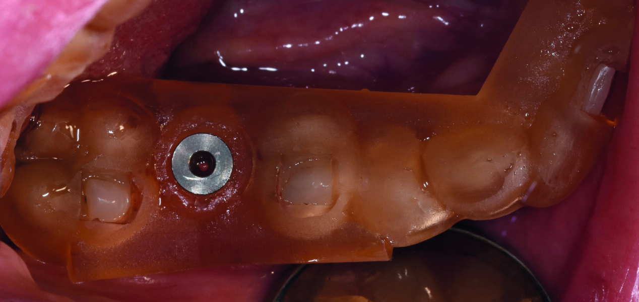 Fig. 11 : Vérification de sa stabilité et de sa parfaite adaptation en bouche grâce aux fenêtres d’inspection. 